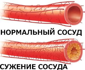 Расширение артериальных сосудов. Сужение просвета кровеносных сосудов.